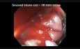 Komplikacje mukozektomii endoskopowej (EMR) - krwawienie z kątnicy - klip C