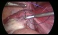 Umocowanie jajnika u ciężarnej pacjentki ze skrętem jajnika 