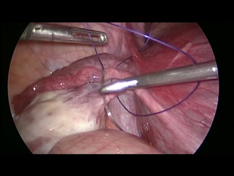 Umocowanie jajnika u ciężarnej pacjentki ze skrętem jajnika 