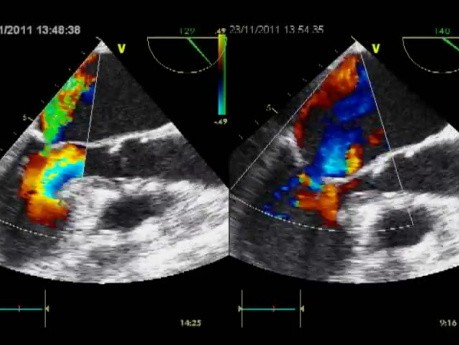 Funkcjonalna niewydolność zastawki dwudzielnej jako główna przyczyna ostrego obrzęku płuc