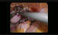 Laparoskopowa operacja rogowej ciąży ektopowej 