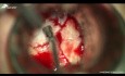 Zastosowanie matrycy TachoSil w celu uszczelnienia płynotoku oraz ubytku kostnego podstawy czaszki podczas operacji guza przysadki mózgowej z dojścia przez zatokę klinową