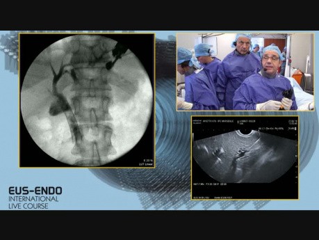 Zabieg wytworzenia hepatogastrostomii pod kontrolą ultrasonografii endoskopowej (EUS)