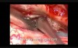 Mikrochirurgiczne usunięcie wewnątrzoponowego, zewnątrzrdzeniowego guza kanału kręgowego o typie oponiaka