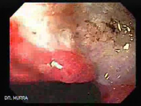 Wrzody u pacjenta z marskością wątroby - olbrzymi wrzód na krzywiźnie mniejszej