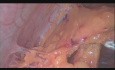 Całkowite laparoskopowe wycięcie macicy, obustronne usunięcie przydatków, pobranie popłuczyn z jamy otrzewnej i biopsja sieci.