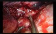 Lobektomia rękawowa guza płuca metodą VATS z użyciem jednego portu (uniportal VATS)