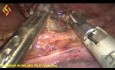 Torako-laparoskopowa resekcja przełyku - część 5