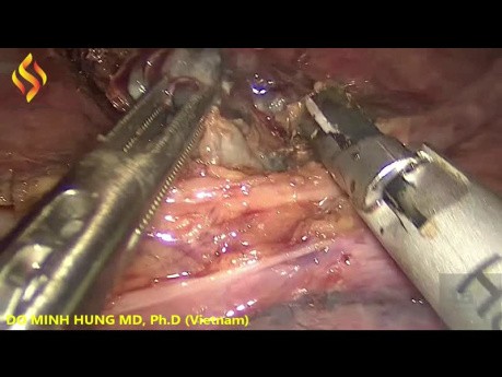 Torako-laparoskopowa resekcja przełyku - część 5