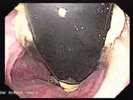 Endoskopowe podwiązanie żylaków - stan po opaskowaniu w inwersji endoskopowej, część 1