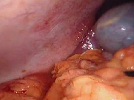 Perforacja okrężnicy z zapaleniem otrzewnej - laparoskopia (2 z 46)