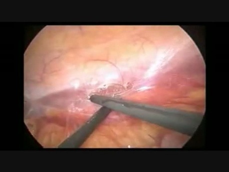 Radykalna nefrektomia laparoskopowa w raku nerki