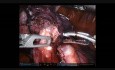 Robotowa częściowa resekcja płuca 