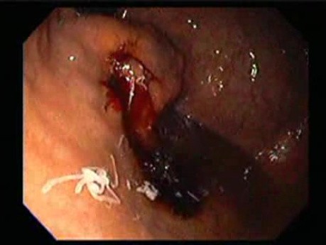 Żylaki żołądka - endoskopowa ablacja klejem cyjanoakrylowym (11 z 18)