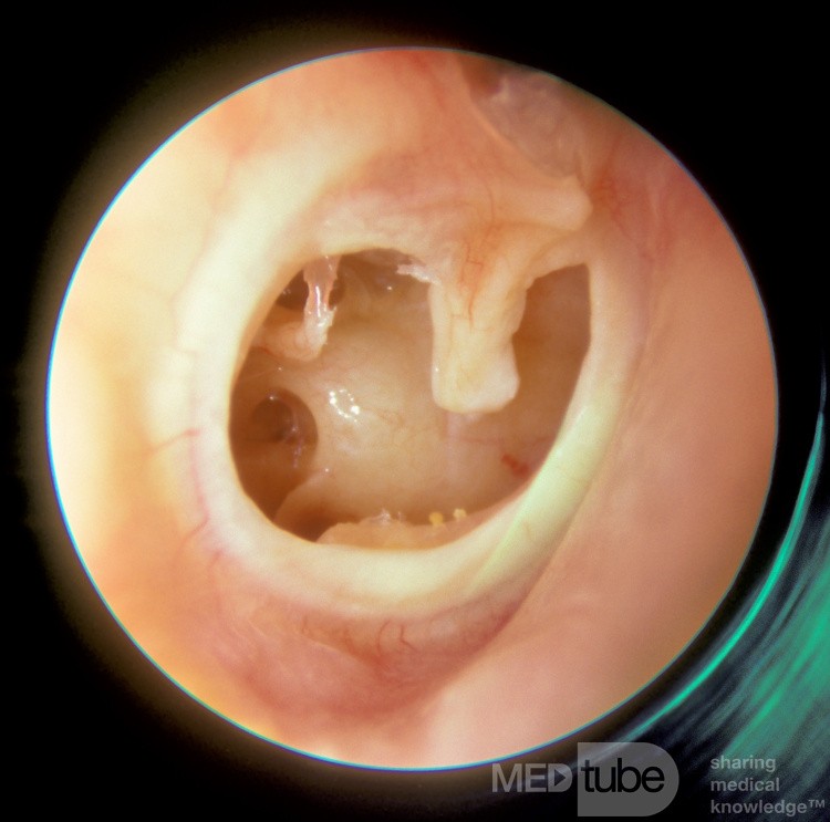 Subtotalna perforacja prawego ucha