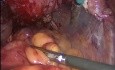 Histerektomia laparoskopowa w miednicy zamrożonej "frozen pelvis"