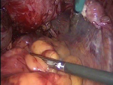 Histerektomia laparoskopowa w miednicy zamrożonej "frozen pelvis"