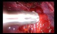 Bezszczelinowa lobektomia dolna lewa z nietypową żyłą języczkową wykonana metodą Uniportal VATS