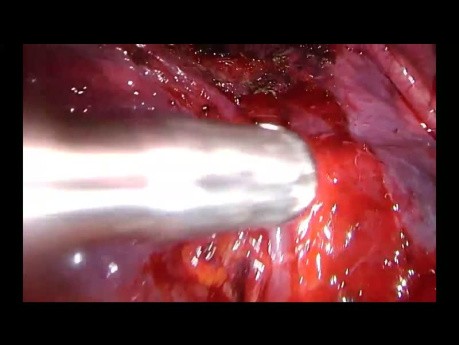 Bezszczelinowa lobektomia dolna lewa z nietypową żyłą języczkową wykonana metodą Uniportal VATS