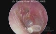 Perforacja zachyłka nadbębenkowego z keratyną i przelotką w uchu