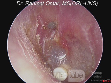 Perforacja zachyłka nadbębenkowego z keratyną i przelotką w uchu