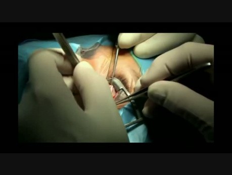 Chirurgiczne leczenie zeza