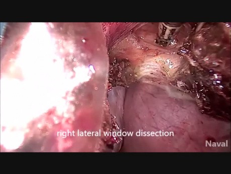 Histerektomia macicy mięśniakowatej (stan po dwóch cesarskich cięciach)
