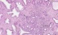 Prostata - Gruczolakorak (Gleason klasa 2) - Badania histopatologiczne