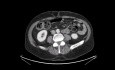 Prezentacja przypadku - lewostronna trisektomia z resekcją płata ogoniastego wątroby z powodu wewnątrzwątrobowego raka dróg żółciowych