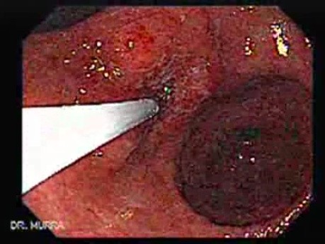 Rak gruczołowy jamy odźwiernikowej i wcięcia kątowego żołądka (3 z 3)