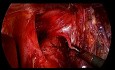 Laparoskopowa gastrektomia D2