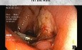 Lit Vasculaire Post Dissection Sous-Muqueuse (ESD) vs Anciens Clips