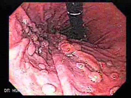 Hiperplastyczna polipowatość żołądka - endoskopia (4 z 6)