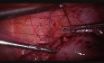 Laparoskopowa miomektomia z kolpotomią