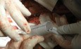Operacja tętniaka aorty piersiowo-brzusznej