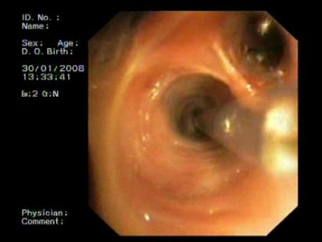 Implantacja zastawki wewnątrzoskrzelowej IBV 