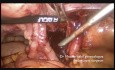Uszkodzenie żyły biodrowej zewnętrznej- naprawa laparoskopowa
