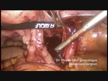 Uszkodzenie żyły biodrowej zewnętrznej- naprawa laparoskopowa