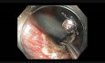Kolonoskopia: zamykanie ubytków po endoskopowej resekcji śluzówkowej 2