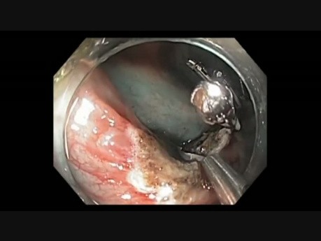 Kolonoskopia: zamykanie ubytków po endoskopowej resekcji śluzówkowej 2