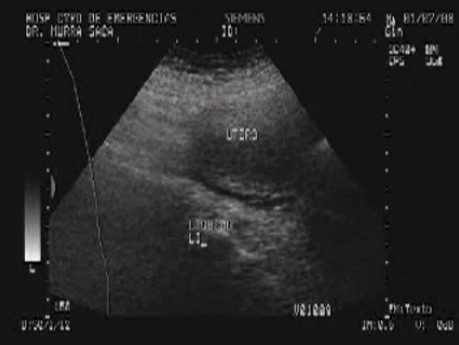 Rak jajnika z przerzutami do żołądka i dwunastnicy - ultrasonografia