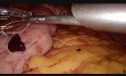 Laparoskopowa plikacja żołądka