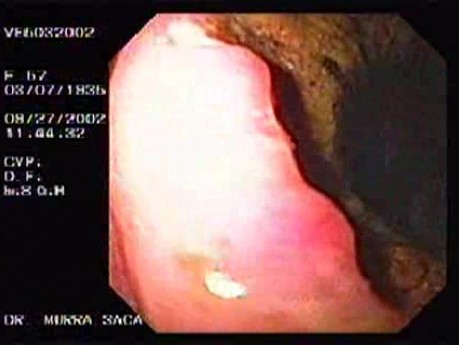 Wrzodziejący gruczolakorak żołądka - endoskopia