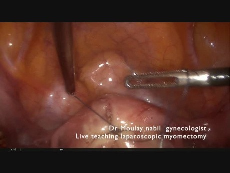 Polimiomektomia laparoskopowa- porady i wskazówki