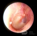Śluzowe zapalenie ucha środkowego (ustępujące)