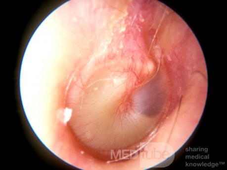 Śluzowe zapalenie ucha środkowego (ustępujące)