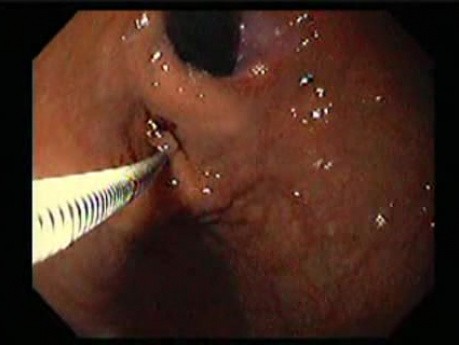 Żylaki żołądka - endoskopowa ablacja klejem cyjanoakrylowym (5 z 18)