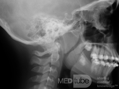 Boczne zdjęcie RTG u pacjenta z powiększonymi migdałkami