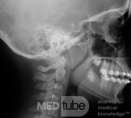 Boczne zdjęcie RTG u pacjenta z powiększonymi migdałkami