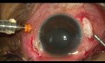 Cud pourazowego zapalenia wnętrza gałki ocznej bez perspektyw poprawy